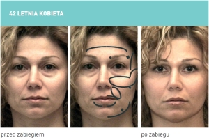 Zdjęcia po zabiegu 1