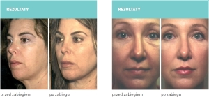 Zdjęcia po zabiegu 2