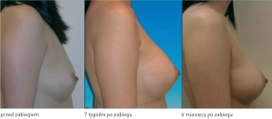 Zdjęcia po zabiegu 4